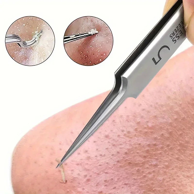Acne Removal Tweezers