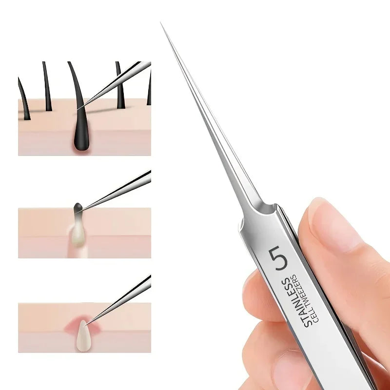 Acne Removal Tweezers